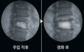 시멘트 경화 확인